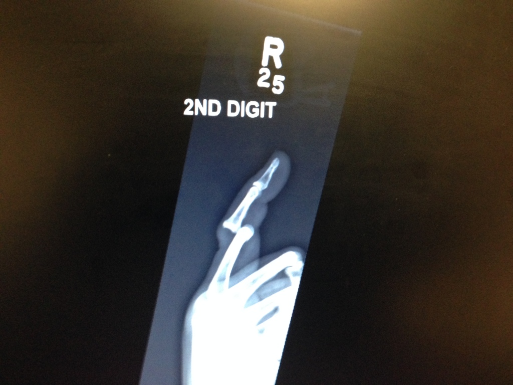Dislocated finger